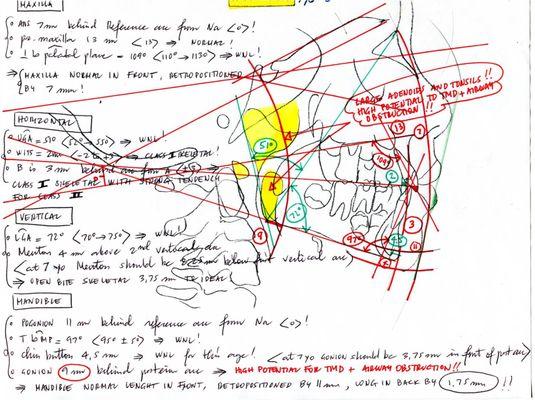 SASSOUN PLUS CEPH ANALYSIS OF A SEVERE TMD AND OSA