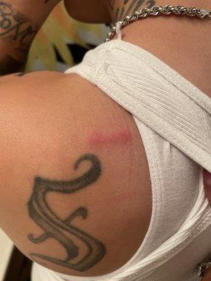 Bedbugs bites