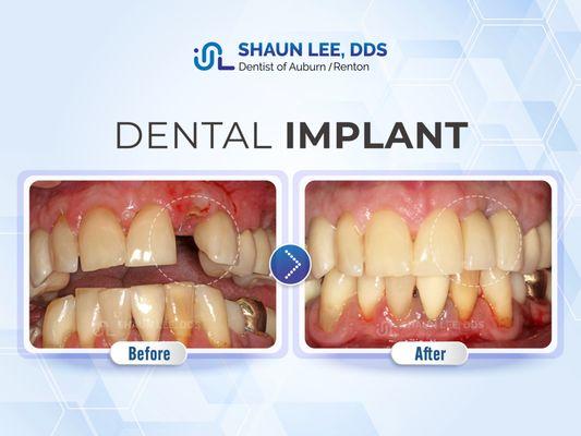 Shaun Lee, DDS Family Emergency Dental Implants of Renton | 10700 SE 174th Street, Suite 204, Renton, WA