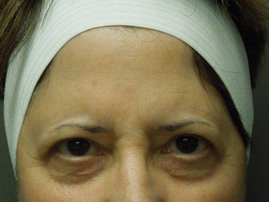 Blepharoplasty Patient 1 (Before)