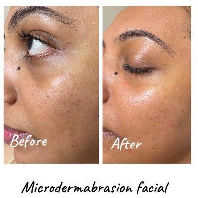 Microdermabrasion facial for blemishes and full skin.