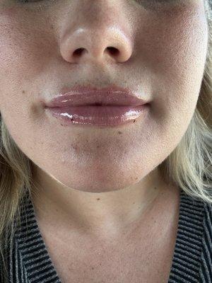 Lip filler