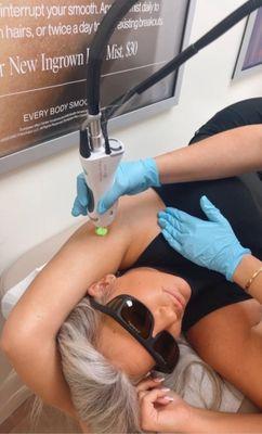 Underarm Laser Hair Removal with the Candela Gentle Max Pro Plus