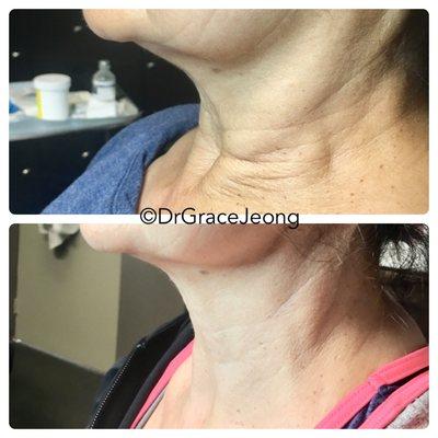 Neck Lift with PDO Threads