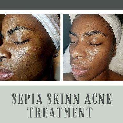 Before and After Signature Acne Treatments. www.sepiaskinn.com