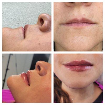 Lip before and after fillers