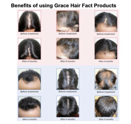 Hair Loss & Restoration Specialists