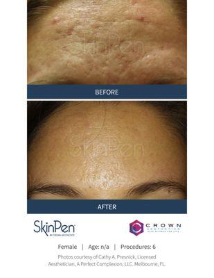 Microneedling