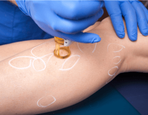 Leg vein treatment