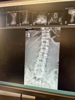 The curve in my spine due to scoliosis.