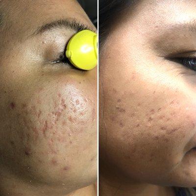 Result of 3 treatment of Radience complexion treatment