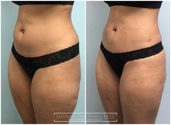 Liposuction of the abdomen, flanks, and saddlebags