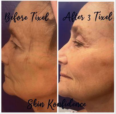 Tixel; skin resurfacing; pigmentation issues; safe for melasma; skin tightening ; anti aging