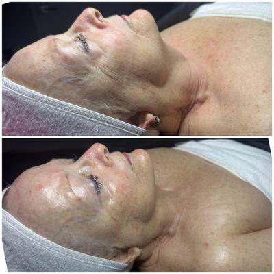 Anti-Aging Facial