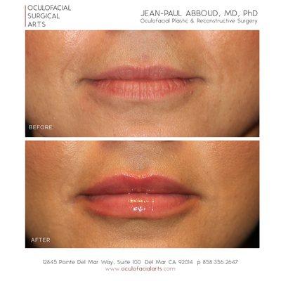 Lip Augmentation/Enhancement