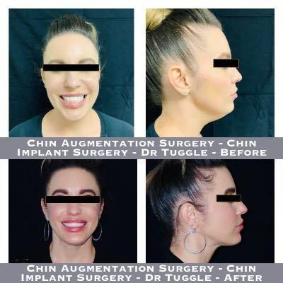 Chin Augmentation Surgery - Chin Implant Surgery - Dr Tuggle - Before-After