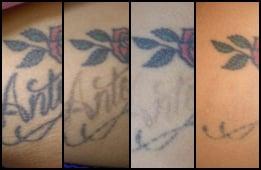 Undoo Tattoo Laser Tattoo Modification Progression Photos