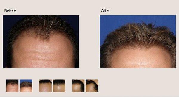 NeoGraft-1 Before & After