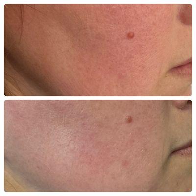 Hydrafacial and microdermabrasion to minimize redness and hydrate her skin