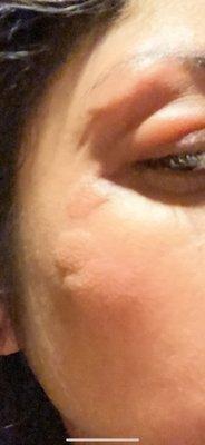 BED BUG BITES ON MY FACE