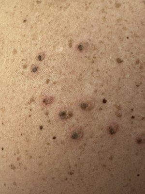 Close up of some of the moles on my back that liquid nitrogen was used on.