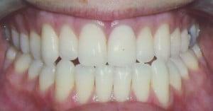 tooth veneers