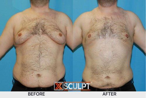 This patient underwent TotalSculpt™ procedure: Gynecomastia correction & liposuction of abdomen & flanks.