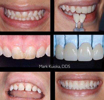 This patient had uneven bondings done that stained over time. Natural looking porcelain veneers resulted in a more esthetic smile.