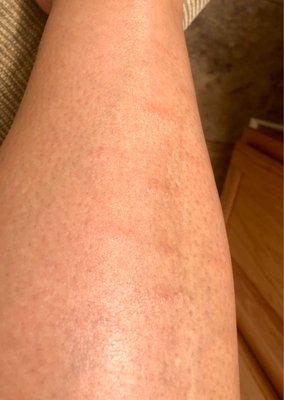 Rash/welts on my leg.