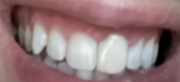 Crown From Sharma Dental