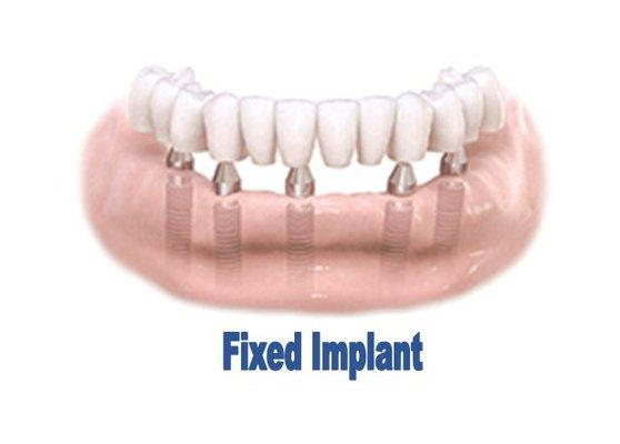 The best option for patients that are missing their teeth. Several implant are placed in the jaw which are screw retained to the implants.