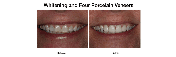 Porcelain Veneers and Teeth Whitening