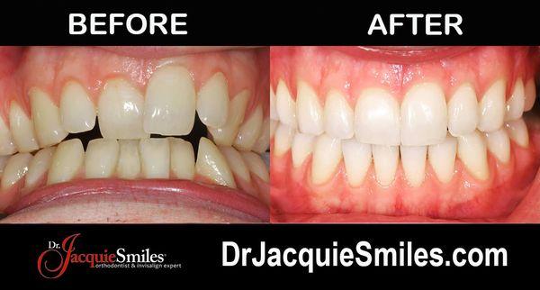 Before and after photo of Invisalign treatment of NYC patient.