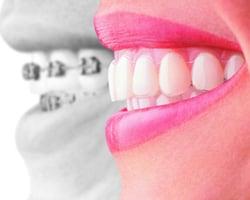 Preferred Provider of Invisalign