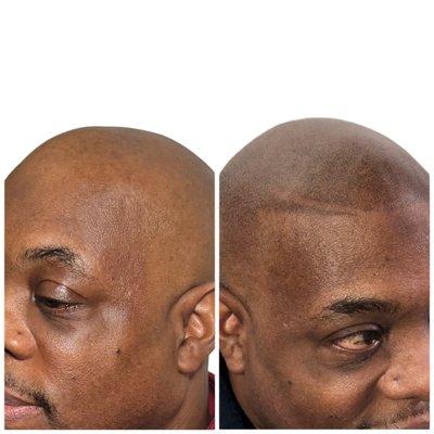 Scalp Micropigmentation with a parting from his youth!