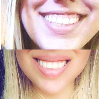 Thank you so so so so so much Kara!!!!! 10 units of dysport helped my smile x1000000. This is a 4 day difference!!!