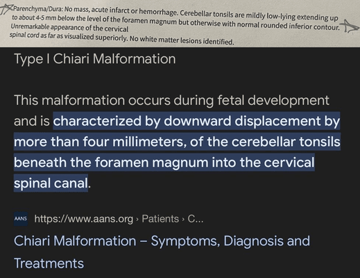 UW's PCPs, ER workers, neurologists missed a Chiari during imaging every time. This Rinky-dink clinic is dangerously incompetent.