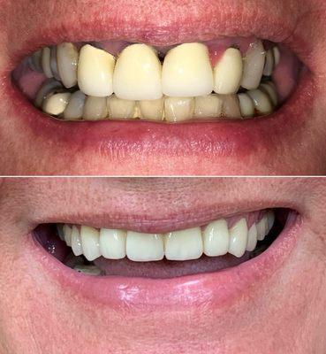 before and after including dental implant bridge along with other single unit crowns