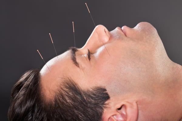 Acupuncture