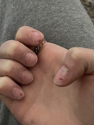 Nail removal gone wrong