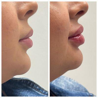 1mL dermal filler before and after