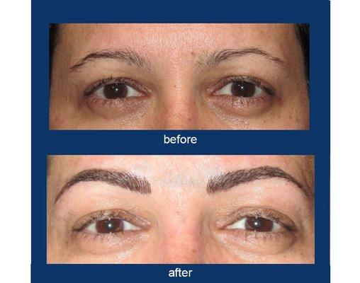 Patchy brows can be filled and shaped naturally with microblading.