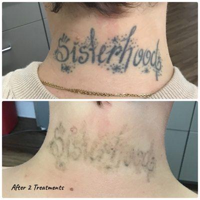 Tattoo removal with PicoSure