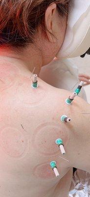 Moxibustion Therapy for frozen shoulder