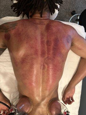 Professional basketball player receiving cupping and Gua Sha treatment on his back.