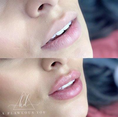 Hydration Lip Fillers $65 This is a no needle procedure.