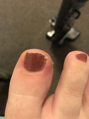 I went to the doctor and he informed me that this was not due to an ingrown toenail, He said it was most likely dirty tools.