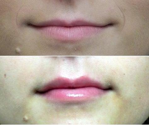 Juvederm to plump lips