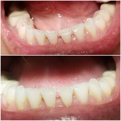 Pitted worn teeth can be enhanced with bonding