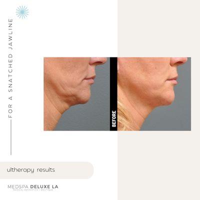 Ultherapy for skin tightening under the chin for a more defined jawline